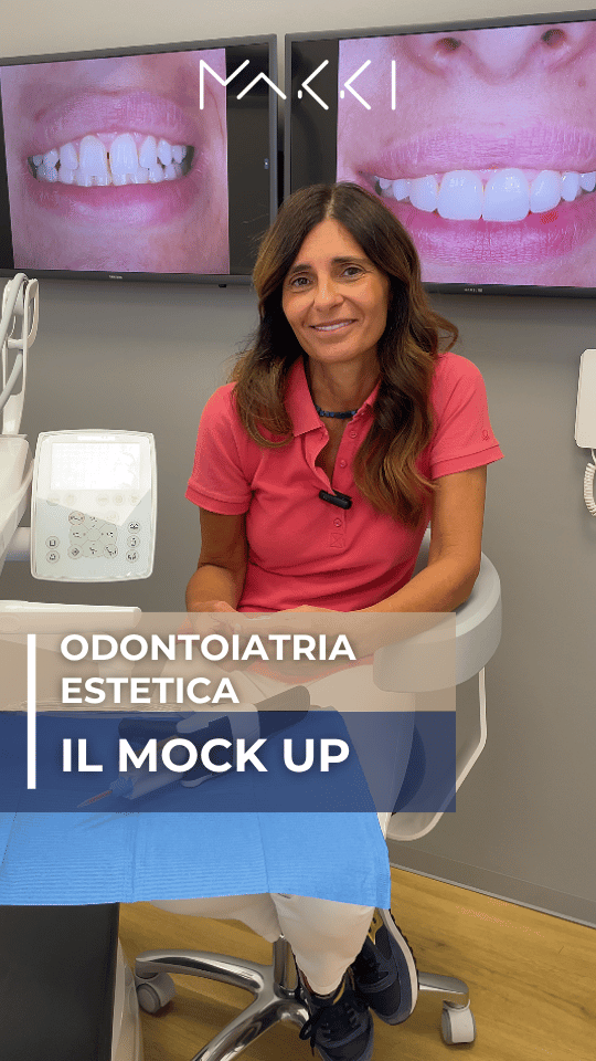 Odontoiatria estetica il Mock up